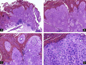 Enfermedad de Bowen. Hematoxilina-eosina A) ×4, B) ×10, C) ×20 y D) ×40 mostrando hiperqueratosis, paraqueratosis y displasia queratinocítica de todo el espesor del epitelio.