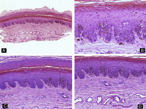 Nevus melanocítico. Hematoxilina-eosina A) ×10, B) ×40, C) ×20 y D) ×20, mostrando una proliferación melanocítica benigna en el lecho ungueal.