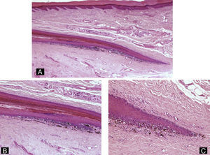 Melanoma in situ. Hematoxilina-eosina A) ×10, B) ×20, C) ×40. Proliferación melanocítica atípica lentiginosa y en nidos ocupando la matriz y el lecho ungueal.