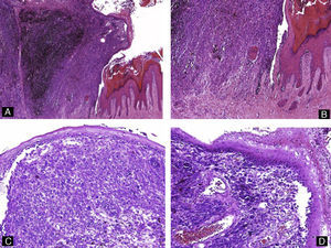 Melanoma maligno subungueal. A) Hematoxilina-eosina ×4. Acantosis e hiperqueratosis del epitelio junto con una tumoración exofítica con abundante melanina. B) Hematoxilina-eosina ×10. Detalle de la morfología fusiforme de los melanocitos invasivos y la proliferación lentiginosa de melanocitos atípicos en el epitelio adyacente. C y D) Hematoxilina-eosina ×20. Gran aumento mostrando los melanocitos atípicos y con actividad mitótica.
