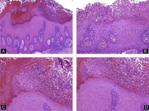 Psoriasis ungueal. Hematoxilina-eosina A) ×10; B, C y D) ×20, mostrando hiperqueratosis, paraqueratosis, hiperplasia psoriasiforme del epitelio y acúmulo de neutrófilos en la capa córnea.