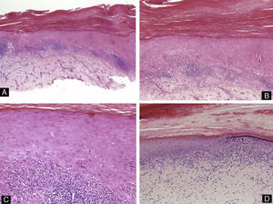 Liquen plano ungueal. Hematoxilina-eosina A) ×10, B) ×20, C) ×40 y D) ×20, mostrando hiperqueratosis, acantosis del epitelio y un infiltrado linfocitario liquenoide en la dermis. Se puede observar la degeneración de la capa basal, con queratinocitos disqueratósicos y cuerpos de Civatte.