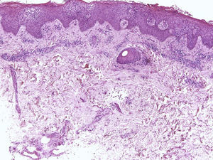 Eccema ungueal. Hematoxilina-eosina ×20 mostrando marcada espongiosis y exocitosis de linfocitos. En la dermis hay un infiltrado linfocitario perivascular.