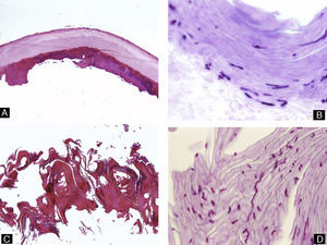 Onicomicosis subungueal distal. A) Hematoxilina-eosina ×10. Lámina ungueal y parte del lecho ungueal adherido a esta que muestra acantosis y presencia anómala de capa granulosa en el epitelio. B) Tinción de PAS ×40 correspondiente a A que revela la presencia de hifas en la parte más profunda de la lámina ungueal. C) Biopsia obtenida por recorte, teñida con hematoxilina-eosina ×10, que consiste en fragmentos de lámina ungueal distrófica, con hiperqueratosis muy marcada. D) Tinción de PAS ×40 que revela hifas en la muestra.