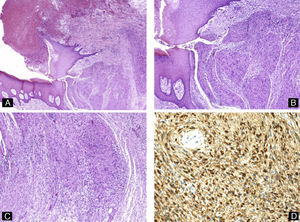 Schwannoma subungueal. A) Hematoxilina-eosina ×10 mostrando ulceración, distrofia ungueal y un tumor polipoide compuesto por células fusiformes. B y C) Hematoxilina-eosina ×20, detalle de la proliferación de células fusiformes con formación de cuerpos de Verocay. D) Tinción inmunohistoquímica para S100, confirmando la positividad de las células tumorales.