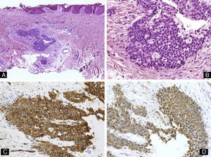 Tumor glómico. A) Hematoxilina-eosina ×10. Muestra un tumor localizado en la dermis, por debajo del lecho ungueal. B) Hematoxilina-eosina ×40 alto poder mostrando las células tumorales, de morfología cuboidal. C) Tinción inmunohistoquímica para actina de músculo liso ×40, mostrando positividad de las células tumorales. D) Tinción inmunohistoquímica para CD34 ×40 mostrando positividad para las células tumorales.