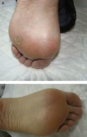A. Paciente 2: Verruga muy dolorosa localizada en el arco plantar anterior del pie izquierdo. B. Paciente 2: 10 semanas después del tratamiento.
