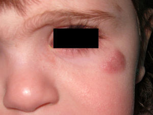 Nódulo eritematovioláceo asintomático en la región superior de la mejilla izquierda.