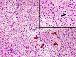 Obsérvese la presencia de un granuloma constituido por histiocitos (flechas rojas). A la derecha de este se aprecia una célula gigante multinucleada (flecha negra), apréciese a mayor aumento en el recuadro superior .Tinción H-E × 20.