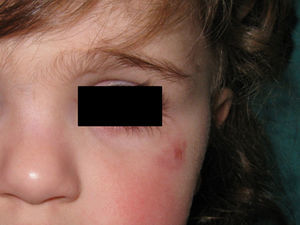 Resolución espontánea de la lesión, persistiendo solo una mácula rosada residual.