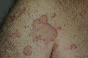 Lesiones eritematoedematosas con borde purpúrico en la raíz del miembro superior.