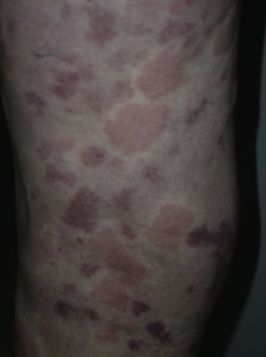 Placas purpúricas residuales y lesiones eritematoedematosas en el miembro inferior.