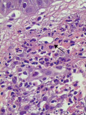 En la parte alta de la dermis se aprecia una zona de leucocitoclastia, con borramiento de la pared vascular (flecha negra). (Hematosilina-Eosina, x400).