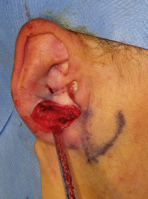 Defecto quirúrgico con afectación de cartílago en antitrago.