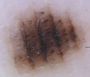 Parallel furrow pattern with globules in the ridges in a melanocytic nevus located on the arch of the right sole of a 33-year-old man.