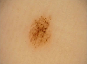 Globular pattern associated with a parallel furrow pattern on the heel of the left sole of a 27-year-old woman.