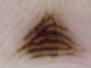 Parallel furrow pattern (double dotted-line variant) in the center of the right palm of a 46-year-old man.
