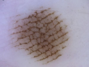 Latticelike pattern in a melanocytic nevus on the external aspect of the left sole of a 53-year-old man.
