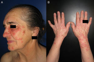 Afectación de áreas fotoexpuestas en una paciente con EMF. Pápulas eritemato-edematosas, algunas con morfología en diana, en área facial (A) y en el dorso de las manos y en los antebrazos (B).