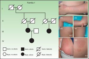 Características clínicas de la familia 1. (a). Paciente de 4 años con malformación arteriovenosa en la extremidad superior izquierda. (b-e). A la exploración se observaban múltiples malformaciones capilares atípicas localizadas en las extremidades superiores e inferiores. La madre de la paciente presentaba malformaciones capilares de gran tamaño en la mama derecha (f), en el muslo derecho y la nalga (g).