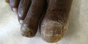 Onychomycosis of the first and second toes of right foot caused by Scytalidium dimidiatum infection, before photodynamic therapy.