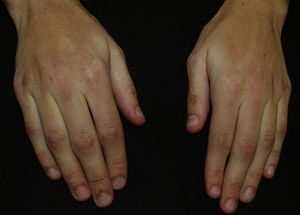 Lesiones eritematosas atróficas localizadas en las articulaciones interfalángicas de los dedos de las manos.