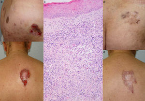 a) Placas con ulceraciones en los glúteos. b) Úlcera de 7×10cm, con forma de herradura, con centro atrófico y borde eritematovioláceo, en la parte superior de la espalda. c) Infiltrado inflamatorio preferentemente folicular con rotura del epitelio folicular y reacción granulomatosa con células gigantes (hematoxilina-eosina, x100). d) Cicatrices residuales en los glúteos. e) Cicatrices cribiformes en la espalda.