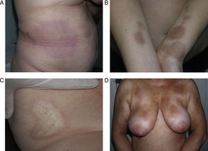 Diferentes aspectos clínicos de la morfea en placas: placa de coloración violácea indicativa de una lesión más inicial e inflamatoria (a); placas hiperpigmentadas con escaso endurecimiento de la piel en las fases más tardías (b); placa de color blanco marfileño, endurecida al tacto (c); múltiples placas hiperpigmentadas de bordes mal definidos en el tronco (d).