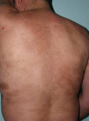Placas de morfea en el tronco de un paciente afectado de fascitis eosinofílica.