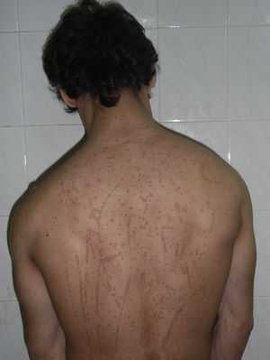 Hundreds of flat warts on the back of the trunk and on the shoulders and arms (Koebner phenomenon).