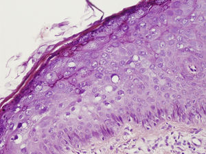 Large keratinocytes with voluminous nuclei, basophilic cytoplasm, and perinuclear halos in the epidermis (hematoxylin and eosin, original magnification 40×).