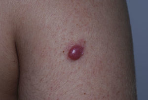 Paciente con LPCBZM que presenta un nódulo único en el brazo.