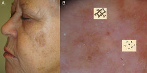 A. Imagen clínica de lentigo maligno. Mácula de pigmentación irregular de color pardo y marrón. B. Imagen dermatoscópica de la lesión donde se observan criterios dermatoscópicos de lentigo maligno en fase incipiente: salidas foliculares asimétricamente pigmentadas y estructuras romboidales.