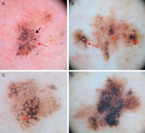 A. Imagen dermatoscópica de lentigo maligno incipiente donde se observan: puntos y glóbulos gris pizarra de distribución irregular (flechas rojas), líneas cortas oscuras y estructuras romboidales incipientes (flecha negra) y pigmentación perifolicular asimétrica (asteriscos). B. Imagen dermatoscópica de lentigo maligno donde se observan salidas foliculares asimétricamente pigmentadas, algunas con signos de oclusión incipiente (flechas rojas). C. En esta imagen se aprecian estructuras en isobaras (asterisco), estructuras romboidales (flecha roja) y salidas foliculares asimétricamente pigmentadas. D. Imagen de lentigo maligno melanoma confirmado histológicamente mediante biopsia tomada de la zona del asterisco, donde se aprecian áreas homogéneas con oclusión de las salidas foliculares.