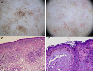 A. Imagen dermatoscópica de lentigo maligno (estructuras romboidales, pigmentación asimétrica perifolicular y patrón granular con glóbulos irregulares con distribución asimétrica). B. Imagen dermatoscópica de queratosis actínica pigmentada (múltiples puntos marrón-grises similares en color y tamaño con distribución principalmente perifolicular, estructuras romboidales). C. Imagen histológica (HE x100) de LM de la figura A: proliferación de melanocitos atípicos distribuidos a lo largo de la unión dermoepidérmica con afectación del epitelio perifolicular. También se observan melanófagos y elastosis solar en la dermis. D. Imagen histológica (HE x100) de la imagen B: queratinocitos atípicos pigmentados en la unión dermoepidérmica. Elastosis solar en la dermis.