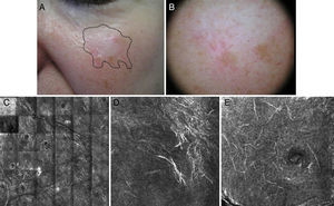 Paciente de 70 años con lentigo maligno recidivado en una cicatriz de crioterapia, localizado en la mejilla izquierda sin biopsia previa. La microscopia confocal demuestra la presencia de células atípicas compatibles con este diagnóstico que se confirma por biopsia. A. Imagen clínica donde se observa una lesión cicatricial hipocroma, posiblemente secundaria a crioterapia, y discreta pigmentación marrón claro inespecífica. Se aprecia el margen positivo por microscopia confocal para orientar el tratamiento. B. Dermatoscopia de la lesión con patrón homogéneo de pigmento sin signos de malignidad. La lesión presenta una cicatriz que distorsiona la estructura de la piel de la zona y borra el patrón típico pseudorreticulado, por lo que no es informativa. C: Microscopia confocal de reflectancia in vivo (VivaScope 1500®). Mosaico en plano de capa espinosa epidérmica con presencia de panal de abejas típico y abundantes estructuras lineales hiperrefráctiles a pequeño aumento, compatibles con células dendríticas melanocíticas en un lentigo maligno melanoma. D. Imagen de 500 micras x 500 micras al nivel del estrato espinoso, con células dendríticas atípicas hiperrefráctiles. E. Imagen de 500 micras x 500 micras a nivel granuloso con presencia de células dendríticas atípicas compatibles con melanocitos en crecimiento pagetoide (imágenes cedidas por cortesía del Dr. Josep Malvehy del Hospital Clinic de Barcelona).