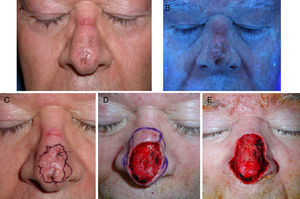 Varón de 65 años afecto de lentigo maligno en el dorso nasal. A. Imagen clínica. B. Mejor delimitación con luz de Wood. Nótese la erosión en el puente nasal secundaria al uso de CPAP. C. Tras la realización de biopsias confirmatorias, dibujo de márgenes basados en la exploración con luz de Wood. D. Defecto tras 2 pases de cirugía de Mohs en parafina, con todos los bordes afectos. E. Defecto final con bordes libres tras 3 pases de cirugía.