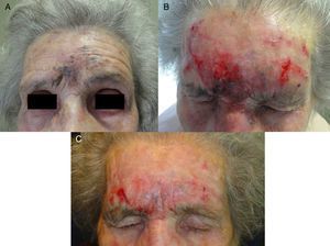 A. Lentigo maligno melanoma (0,125mm de Breslow tras la biopsia diagnóstica) en la frente de una paciente de 94 años. B. Importante reacción inflamatoria tras 2 meses de tratamiento. C. Hiperpigmentación grisácea interciliar residual tras 3 meses de tratamiento. El resultado histológico tras la biopsia descartó la persistencia tumoral.