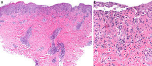 a) Infiltrado inflamatorio linfohitiocitario perivascular y profundo, con afectación de la unión dermoepidérmica (H-E, ×10). b) Detalle que muestra la alteración de la interfase, la necrosis fibrinoide de la pared vascular y aislados queratinocitos necróticos (H-E, ×40).