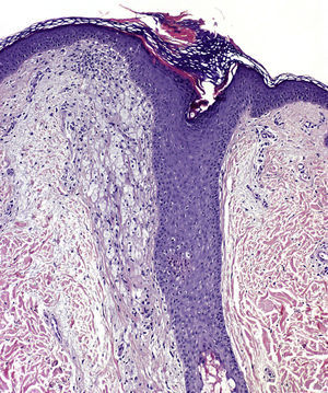 Dilatación y taponamiento hiperqueratósico del infundíbulo folicular, rodeado por abundantes macrófagos xantomizados (H-E × 50).