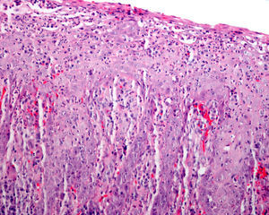 Biopsia de paladar blando, que demostraba un marcado exudado neutrofílico con signos de regeneración epitelial y mínimo infiltrado inflamatorio (H-E × 200).