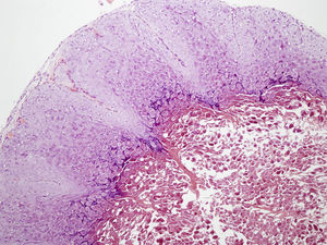 Histopatología: molluscum contagiosum. Se observan cuerpos de inclusión en los queratinocitos. Hematoxilina-eosina × 10.