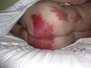 Imágenes en chorreras sugiriendo un líquido como posible causante de la dermatitis.