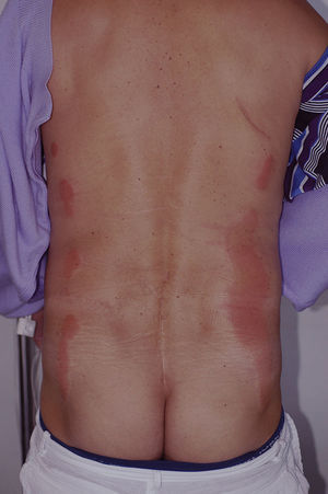 Lesiones paralelas en la zona lumbar tras la aplicación de povidona yodada como antiséptico en una intervención de colectomía.