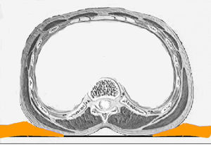 Gráfico explicactivo del cúmulo de antiséptico en la zona lumbar en pacientes intervenidos en decúbito supino.