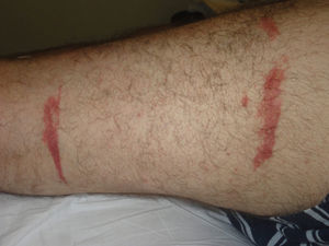 Lesiones en el borde del manguito de hemostasia. Este fue protegido con venda y algodón, que se impregnó de povidona yodada.