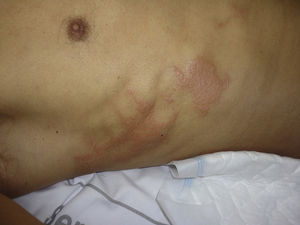 Lesiones irritativas por povidona yodada en el tórax anterior en un paciente intervenido en decúbito prono de artrodesis lumbar.