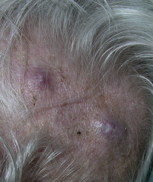 Metástasis de carcinoma folicular de tiroides. Nódulos violáceos con telangiectasias superficiales en el cuero cabelludo.