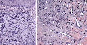 Imágenes histológicas de metástasis cutáneas. A. Metástasis dérmica por carcinoma pobremente diferenciado de origen desconocido. Infiltración de la dermis por cordones y nidos de células epitelioides (H-E x10). B. Metástasis dérmica por adenocarcinoma pancreático moderadamente diferenciado. Luces glandulares tapizadas por una capa de células epiteliales entre los haces colágenos dérmicos (H-E x10).