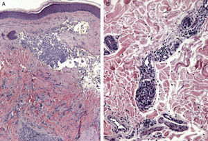 A. Metástasis dérmica por carcinoma de ovario. Vasos sanguíneos en La dermis dilatados y ocupados por células epiteliales atípicas (H-E x20). B. Infiltración dérmica y vascular extensa (linfangitis carcinomatosa) por un carcinoma pobremente diferenciado.